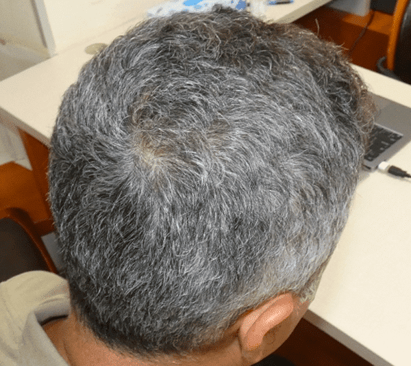 אחרי טיפול PRP